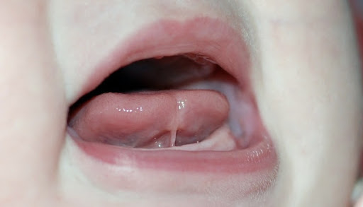 Trẻ tự kỷ ngắn phanh lưỡi là nguyên nhân gây hạn chế khả năng nói 